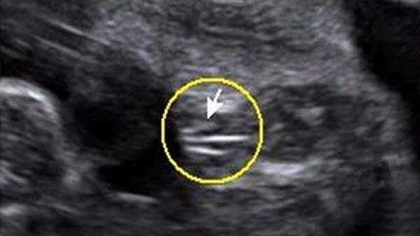 四维彩超图片看胎儿容貌出生后对比图